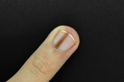 Evaluation of nail lines: Color and shape hold clues | Cleveland Clinic  Journal of Medicine