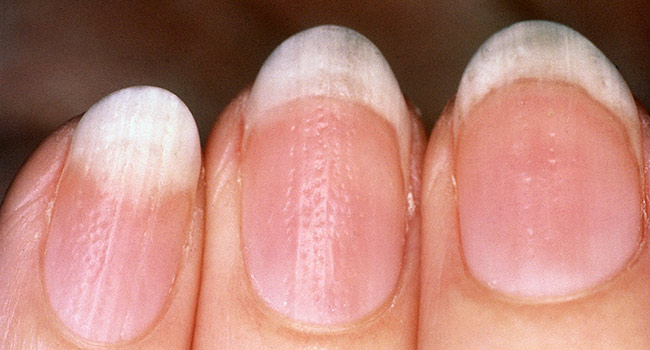 Nail Psoriasis: Causes, Symptoms, and Treatment - Blog