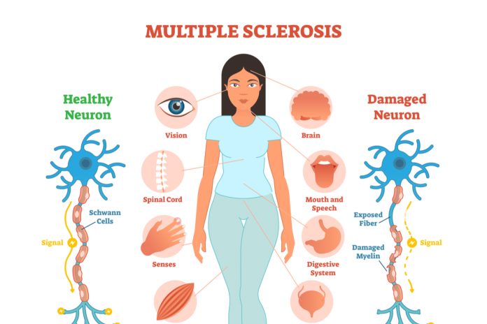 Multiple Sclerosis Linked To Infection In Adolescence – New Study