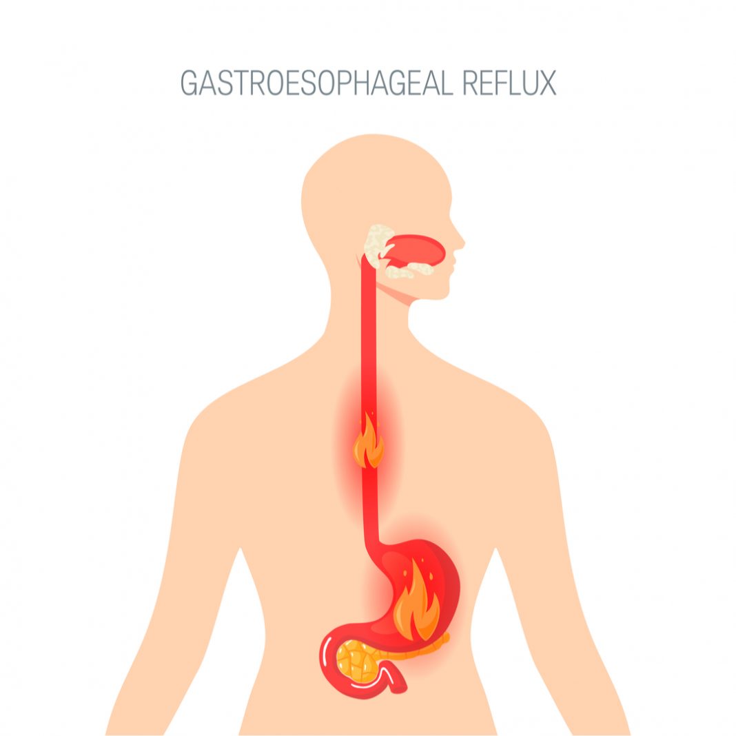 Ease heartburn and acid reflux with these foods and drinks Ease heartburn and acid reflux with these foods and drinks
