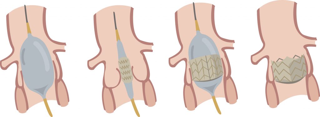 Transcutaneous Aortic Valve Replacement’ technique is now available in Mumbai